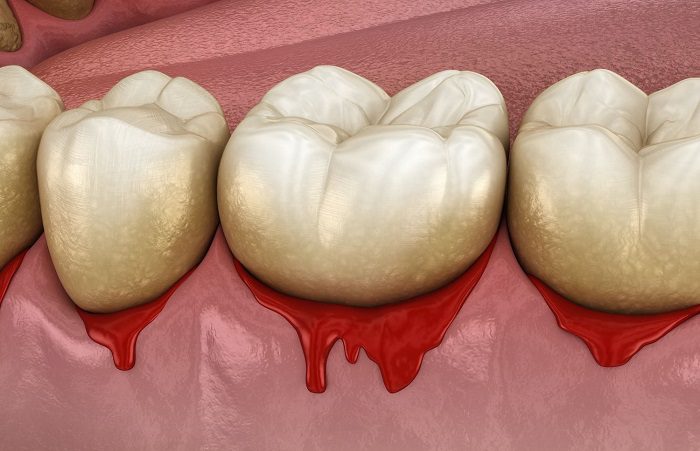 Do Your Gums Bleed When You Floss? - Greenville, TX Dentists