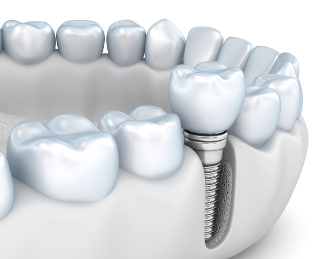 How Teeth Affect the Jawbone